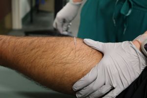 A close up image of what dry needle therapy looks like