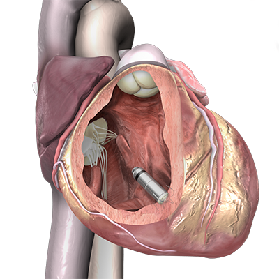 Three dimensional rendering of a leadless pacemaker.
