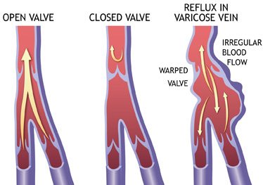 varicose veins illustration.